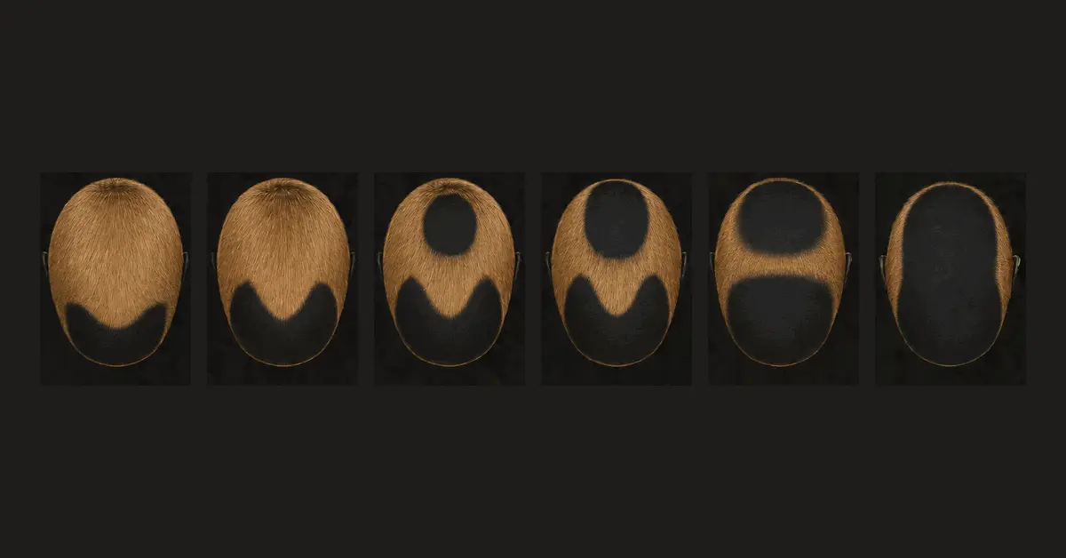 Escala Norwood — a progressão da calvície masculina do grau II ao VII