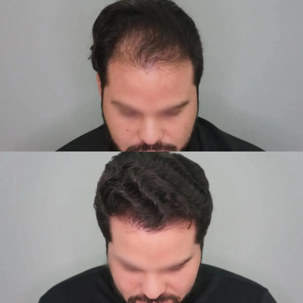 Antes e depois de transplante capilar FUE