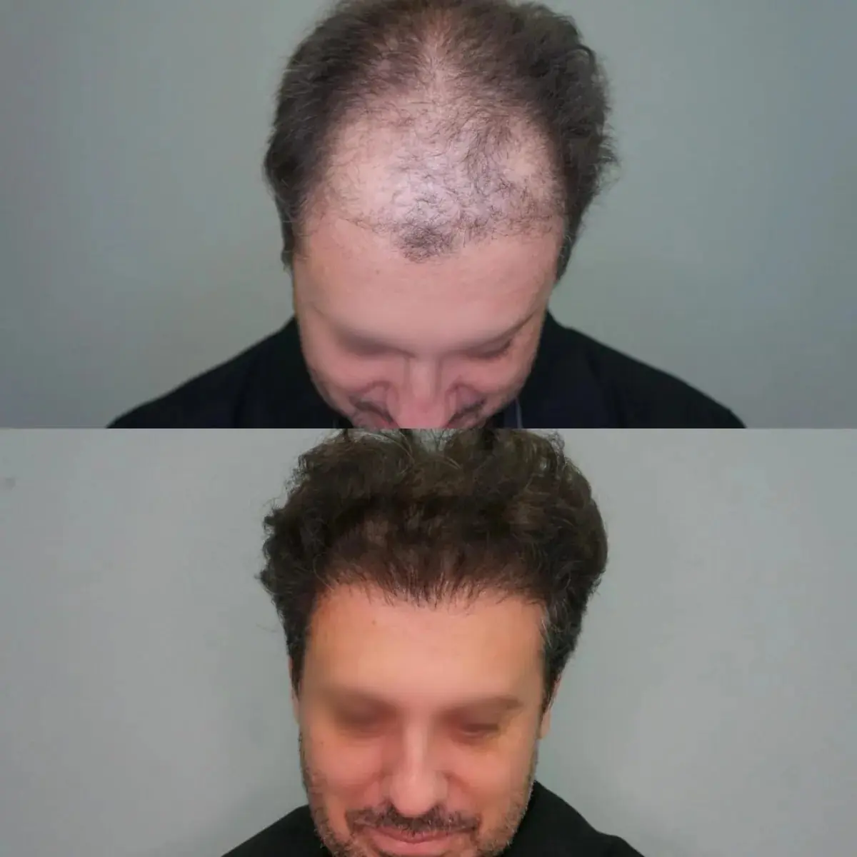Antes e depois de transplante capilar FUE