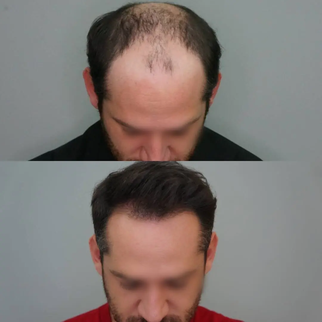 Antes e depois de transplante capilar FUE