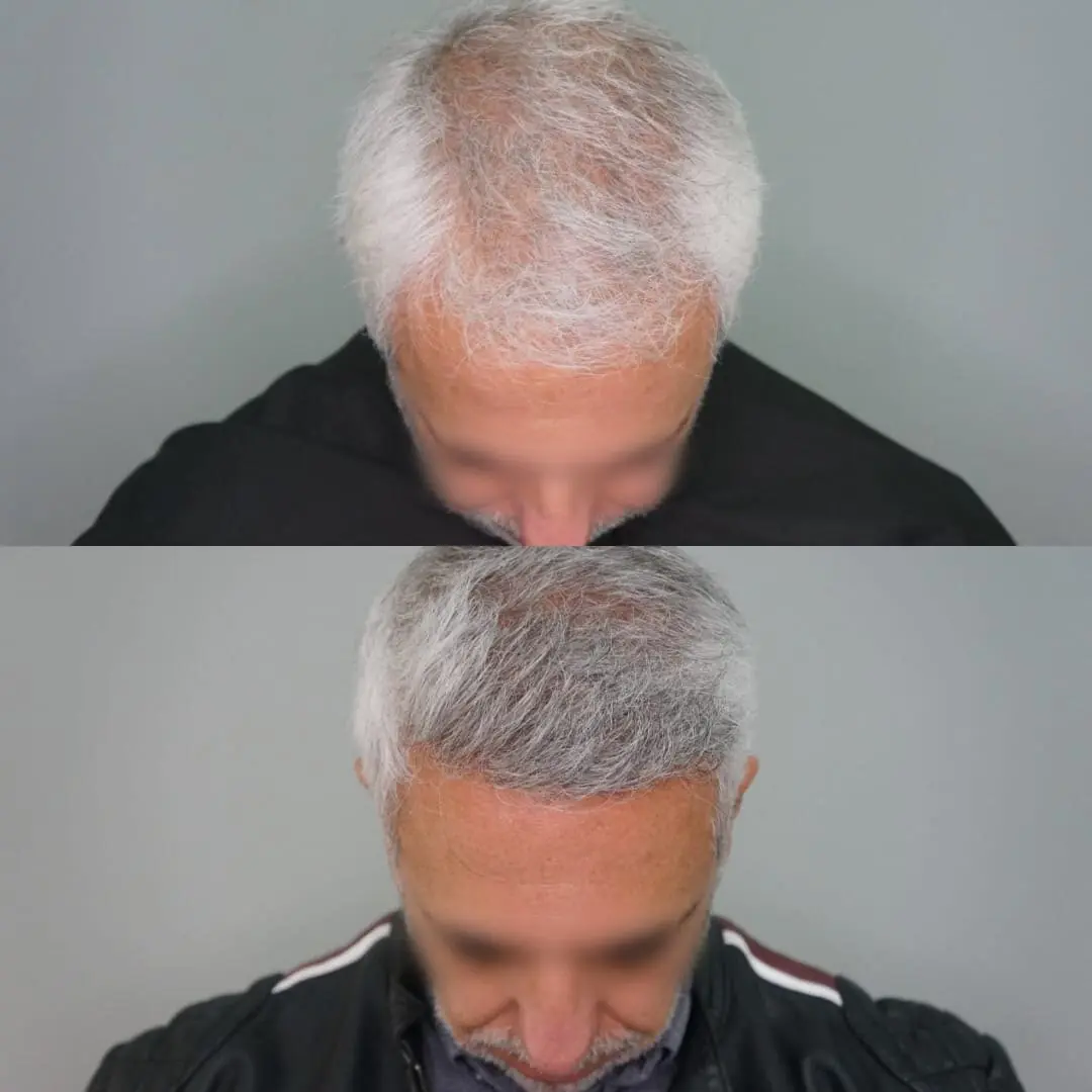 Antes e depois de transplante capilar FUE