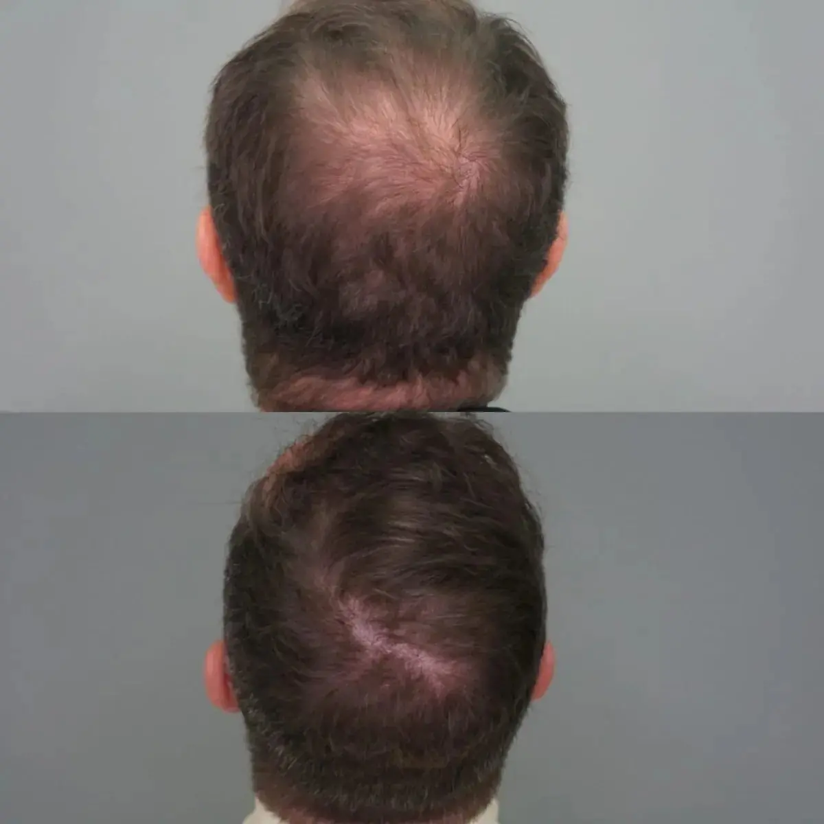 Antes e depois de transplante capilar FUE