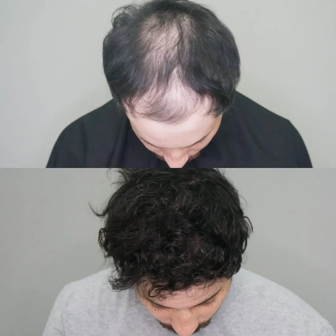Antes e depois de transplante capilar FUE